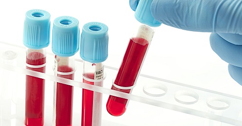 Blood test to identify women at risk of preterm birth