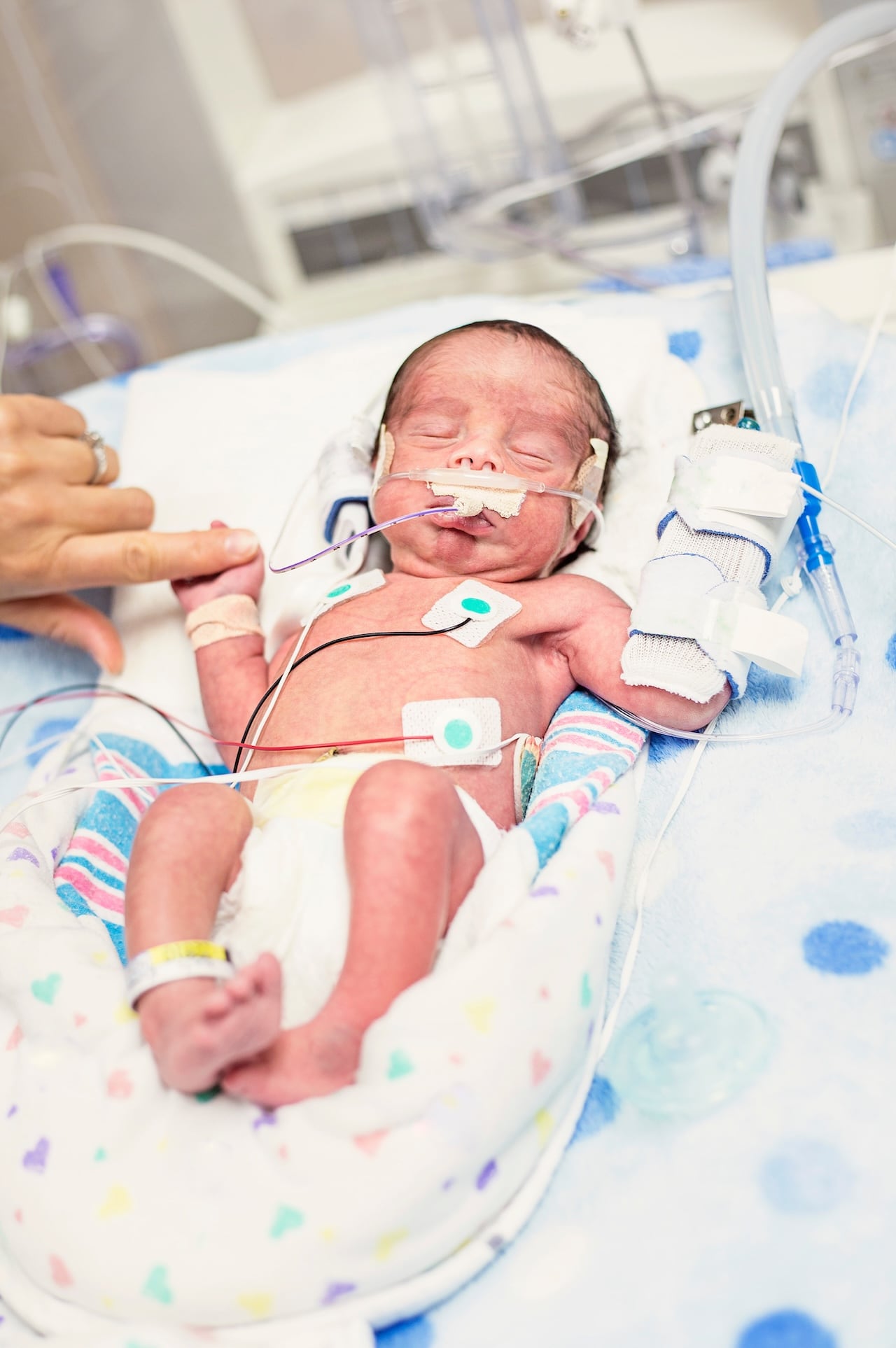 Preterm_birth